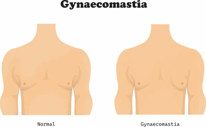 Gynecomastia Explained Causes, Symptoms, Treatment